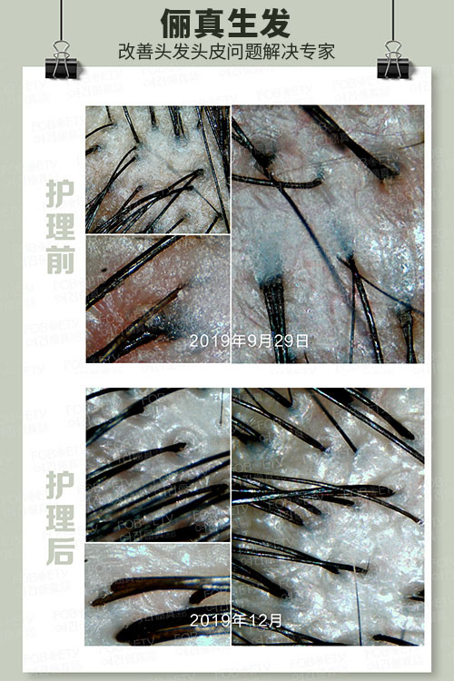 頭油、頭癢