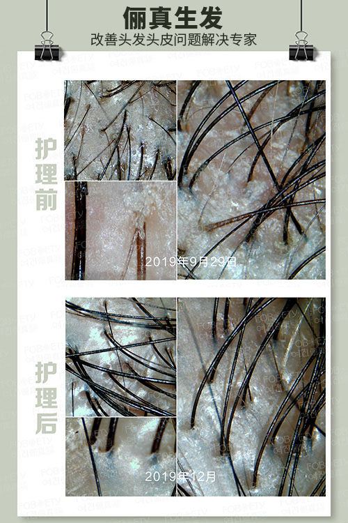 頭油、頭癢